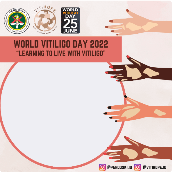 Download Twibbon Hari Vitiligo Sedunia Tahun 2022
